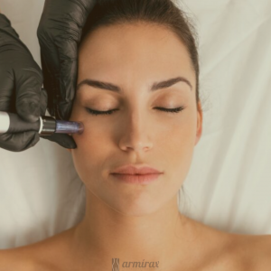microneedling